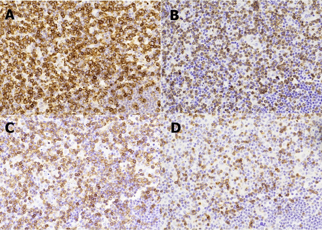 A panel of immunohistochemical stains show the T-lymphocytes are positive for CD2 (A) with partial loss of CD3 (B), CD5 (C), and CD7 (D) expressions. (Immunoperoxidase staining; original magnification, x 200).