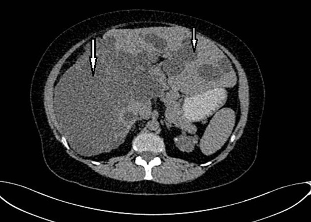 Non-contrast CT shows multiple liver cysts with variable size and multiple renal cysts.