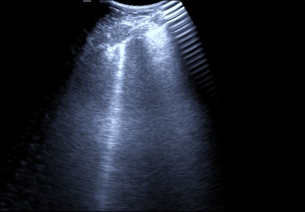 Real time chest ultrasound showing Kerley’s B lines in patient with covid -19.