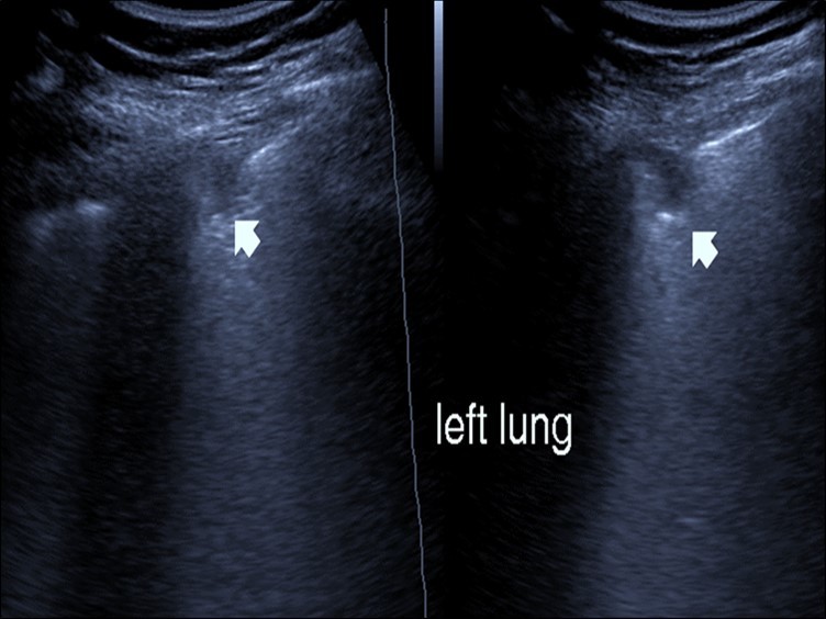 Chest ultrasound showing subpleural consolidation in patient with Covid-19.