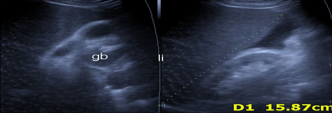 Real time ultrasound showing mild hepatomegaly (li), ascites and thickened gall bladder wall(gb).