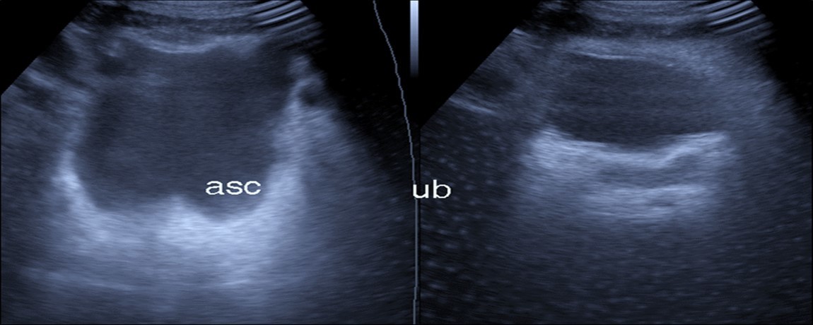 Real time ultrasound showing free ascites (asc) in patient with Covid-19.