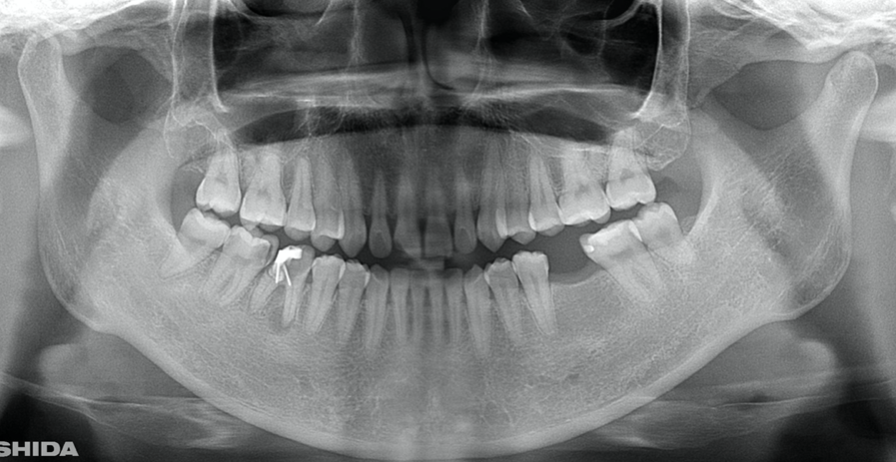 Clinical case of right auto transplantation. Panoramic view at initial examination.Tooth #46 was shown to be half decayed and a cystic lesion was found in the mesial root apex. Tooth #36 was lost, while #48 and #38 were present. There was a total of 29 teeth in the oral cavity.