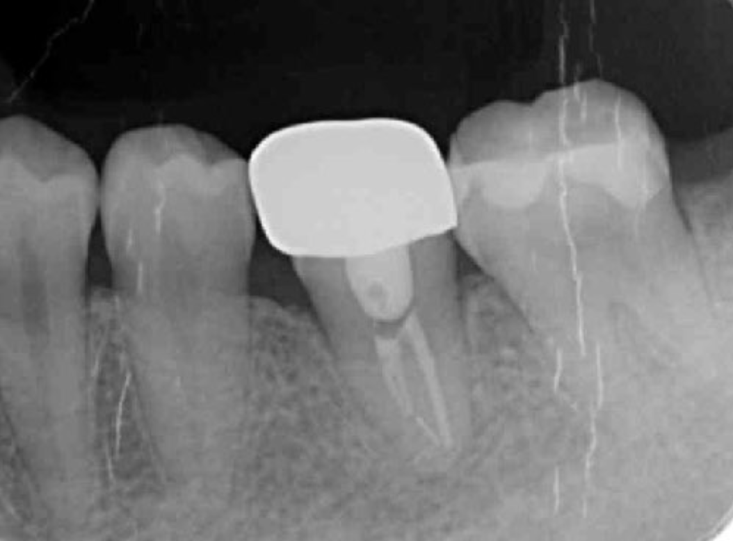 Intraoral photo obtained after setting the donor tooth into the socket of the recipient.