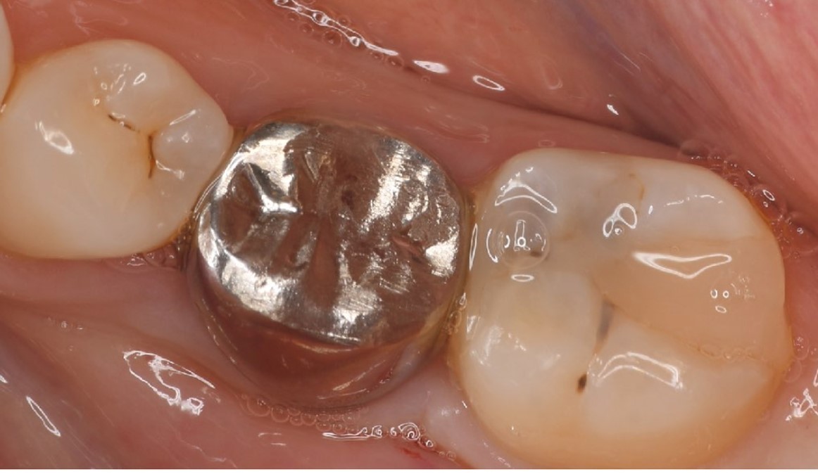 Dental X-ray image obtained after confirmation of definitive prosthesis. Bone regeneration can be seen around the root of the donor tooth.