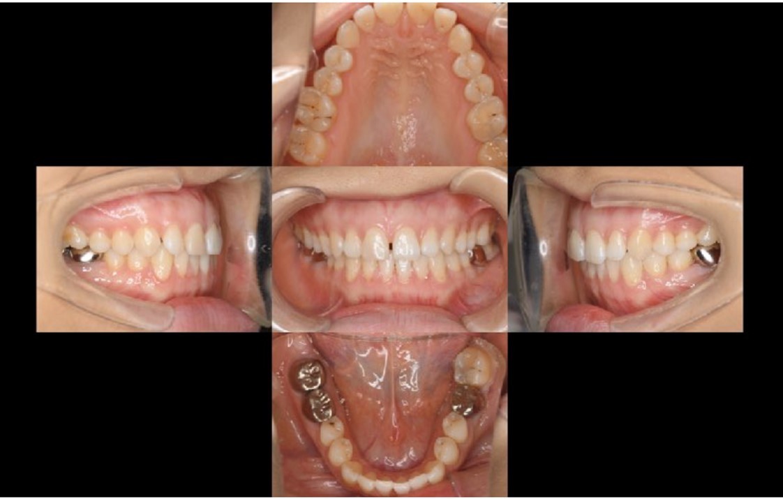 Panorama X ray image obtained one year after procedure for #36. The transplanted teeth demonstrated good function.
