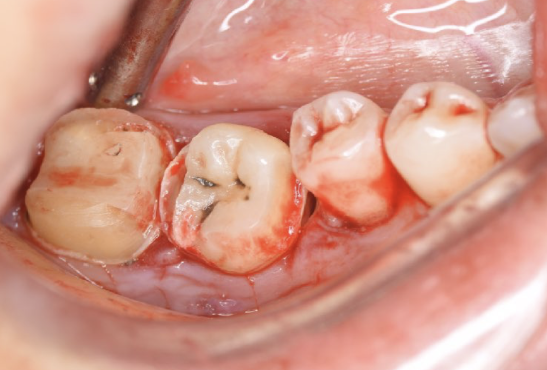 Confirmation of fit of donor tooth in socket. The metal crown for #47 was also detached during tooth extraction.
