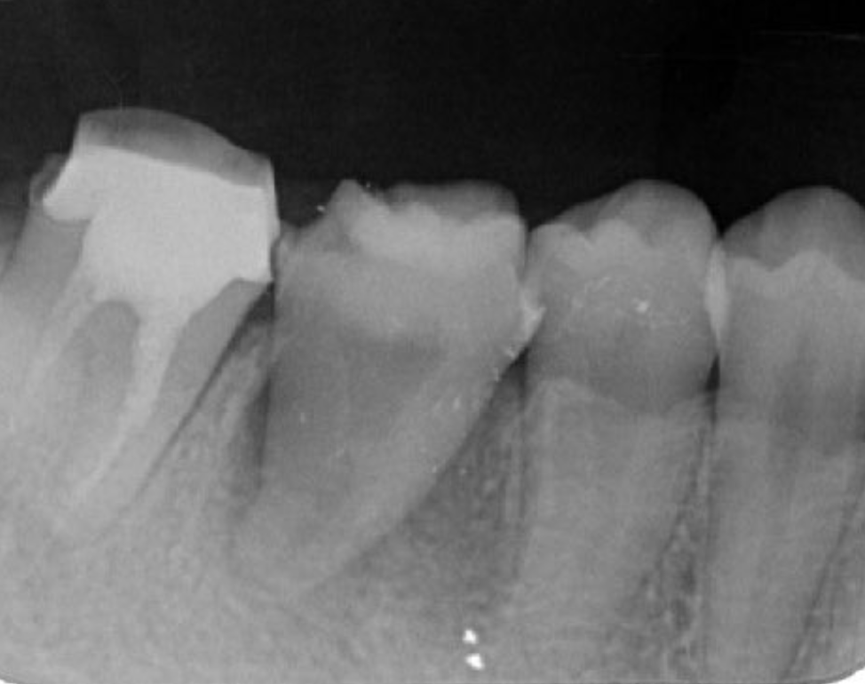 Dental X-ray image obtained after transplantation.