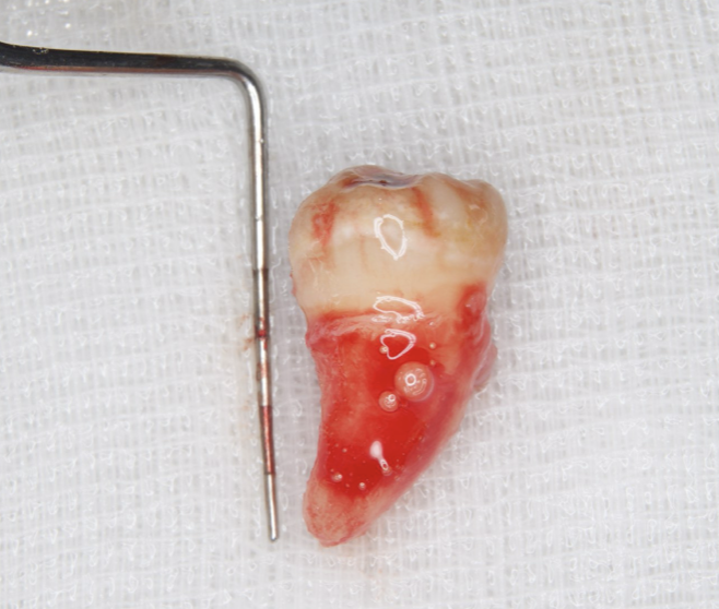 Dental X-ray image obtained two years after transplantation. Bone regeneration around the grafted tooth was confirmed.