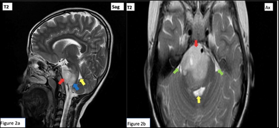 T2 Weighted cranial magnetic resonance imaging sagittal (a) and axial (b) cuts.