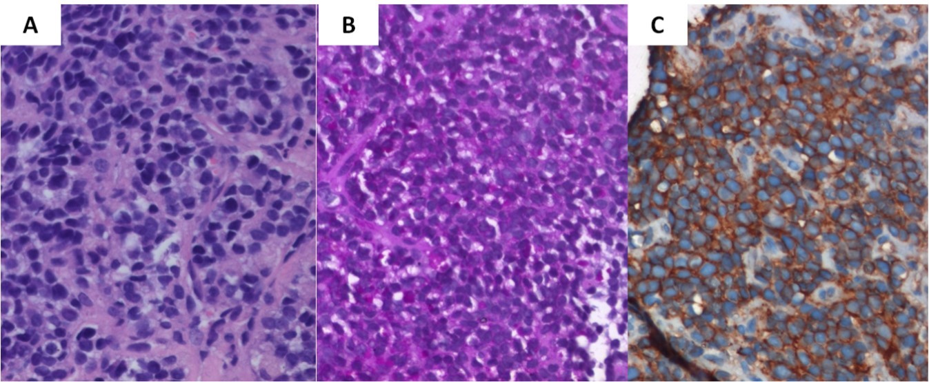 Biopsy from the tibial lesion (A) showed ‘undifferentiated small blue round cells’ on light microscopy (X400, hematoxylin & eosin). Vacuolated cells were positive for Periodic Acid Schiff stain (B), while small blue round cells showed diffuse membrane positivity for Mic-2 (C)