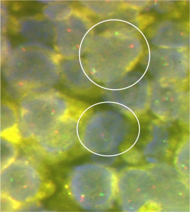 Representative photomicrograph of interphase fluorescence in-situ hybridisation (FISH) for Ewing’s sarcoma breakpoint region 1 (Vysis EWSR1 dual colour break apart kit; Abbott Molecular Inc.) showing spilt red and green signals (as shown by the encircled circles) indicating EWSR1 gene re-arrangement strongly supportive of a diagnosis of Ewing’s sarcoma