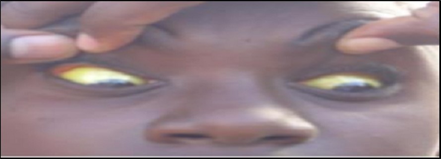 Jaundiced eye sclera of human (source: Gong et al. 22