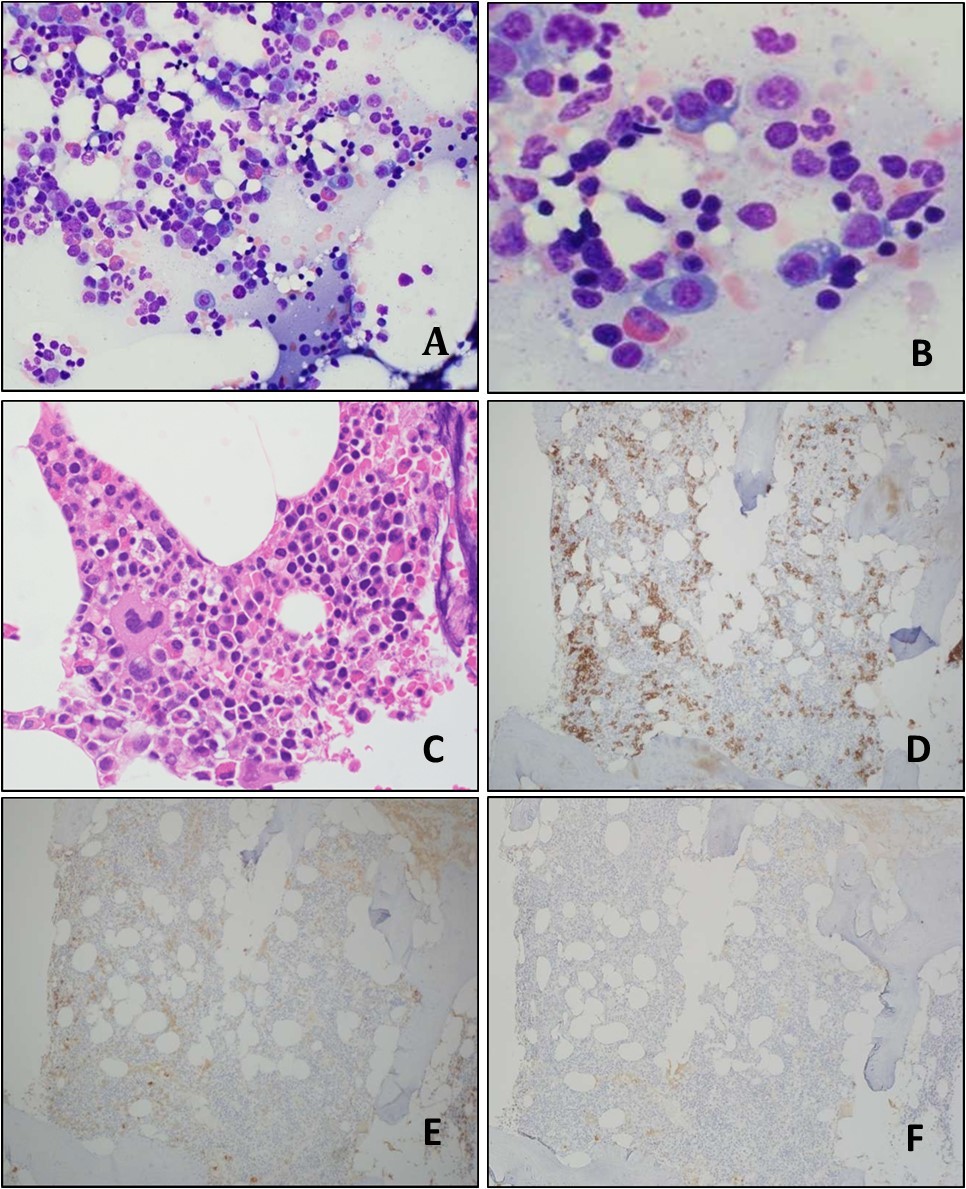 Bone marrow aspirate smear (A-B) and bone marrow biopsy (C) show normocellular bone marrow with normal trilineage hematopoiesis and slightly increased plasma cells; blasts are not increased. Immunohistochemistry (IHC) performed on the bone marrow biopsy sections show the CD138-positive plasma cells are mildly increased in number, but <10% of all bone marrow nucleated cells (D); they are positive for lambda light chain (E), but negative for kappa light chain (F). (A, Wright-Giemsa stain, original magnification, × 400; B, Wright-Giemsa stain, original magnification, × 600; C, H&E stain, original magnification, × 600; D-F, IHC stains, original magnification, × 100).
