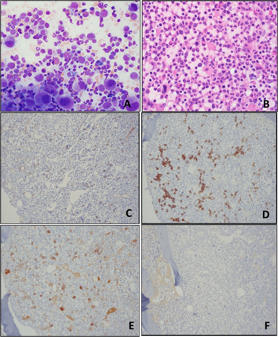 Bone marrow aspirate smear (A) and bone marrow biopsy (B) show markedly hypercellular bone marrow with granulocytic hyperplasia, erythroid hypoplasia, and megakaryocytic hyperplasia with “dwarf” megakaryocytes containing mono-/hypolobated nuclei; sheets of blasts are not seen. Immunohistochemistry (IHC) performed on the bone marrow biopsy sections show <5% CD34-positive blasts (C); CD138-positive plasma cells are <5% of all bone marrow nucleated cells (D); the plasma cells are positive for lambda light chain (E), but negative for kappa light chain (F). (A, Wright-Giemsa stain, original magnification, × 400; B, H&E stain, original magnification, × 600; C-F, IHC stains, original magnification, × 100).