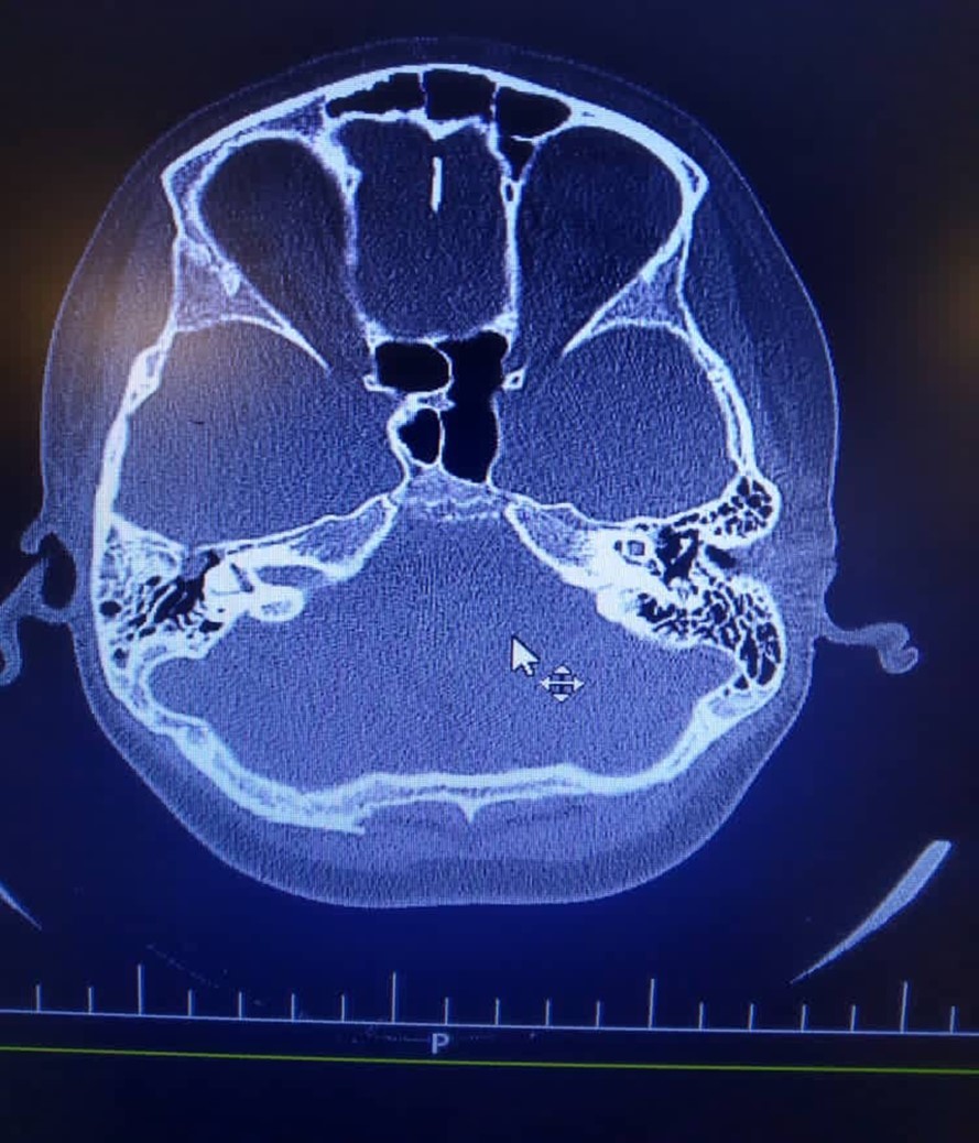 There is evidence of fracture on the right roof of the right tympan. Slight opacity of right mastoid air cells is evident. There is soft tissue density in the middle ear and epitympan and preusak cavity suggestive cholesteatoma.