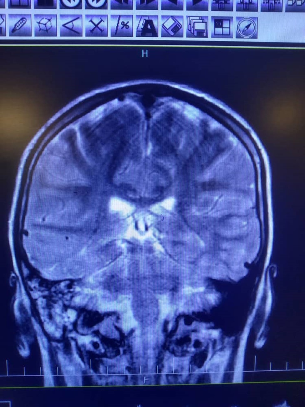 High signal intensity in both hemispheres is noted suggestive of meningitis. In T2 sequence there are hyper signal material left maxillary sinuse and bilateral frontal sinuses in favour of sinusitis, polyp and retention cyst in left maxillary sinus is noted. Effusion in right mastoidal air cell is noted.