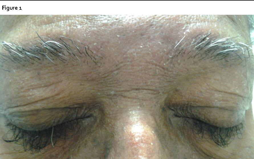 Note loss of eyebrow hair with paradoxical trichomegaly and trichiasis of the eyelashes.
