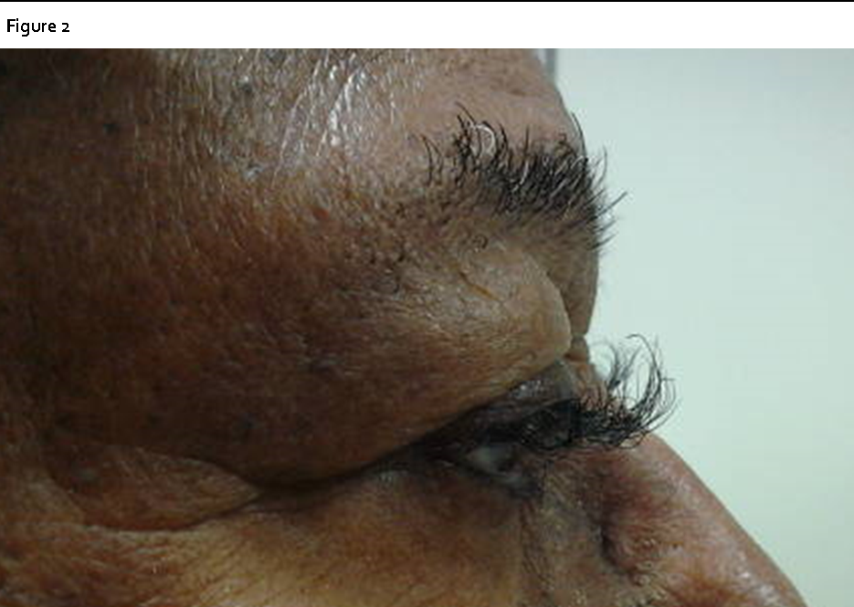 Note loss of eyebrow hair with paradoxical trichomegaly and trichiasis of the eyelashes.