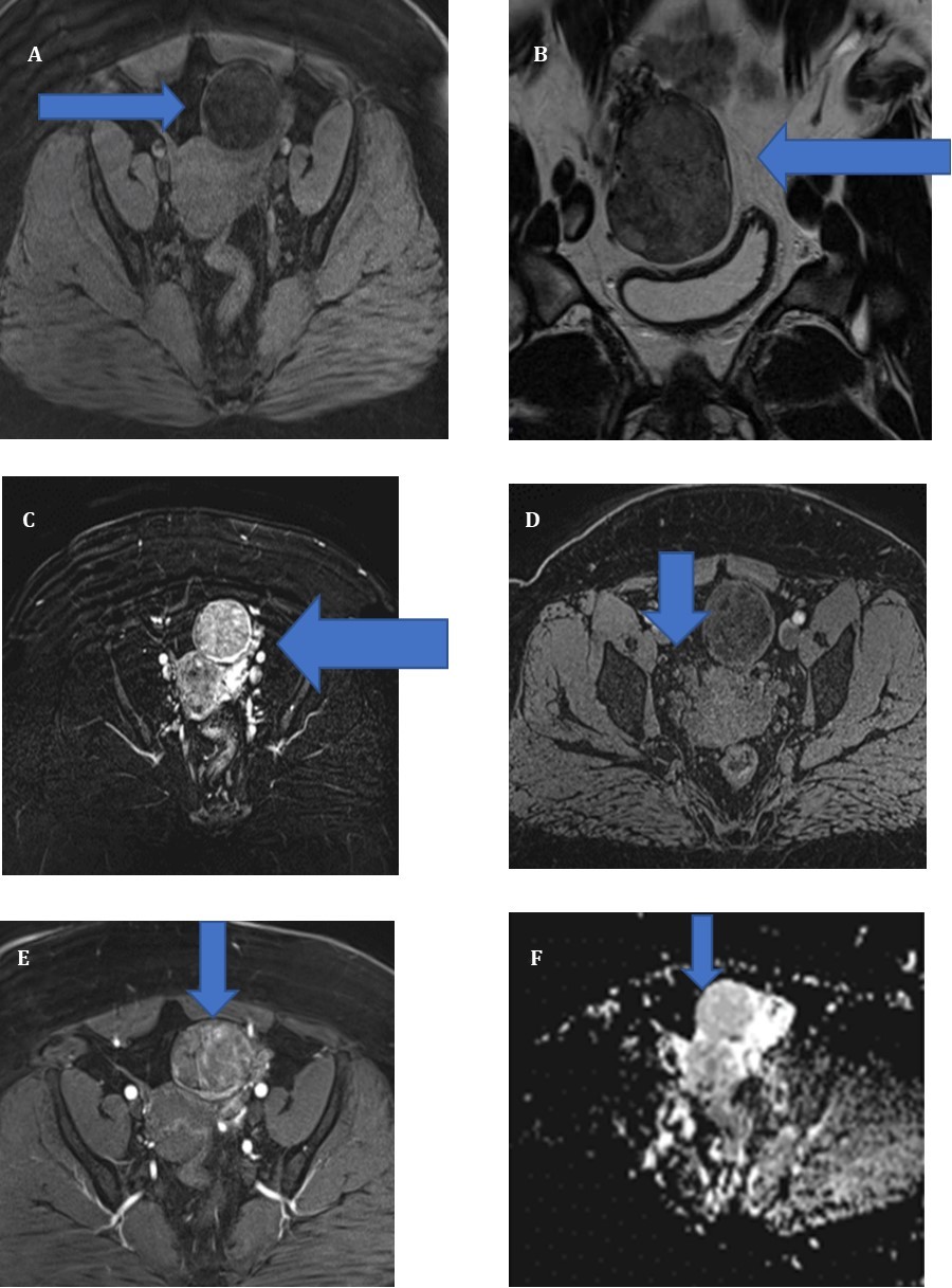 Sequence T1 without contrast B) Sequence T2 without contrast c) T2 with contrast GADO D) Sequence T1 with contrast GADO E) Sequence T1 with contrast GADO F) Sequence diffusion