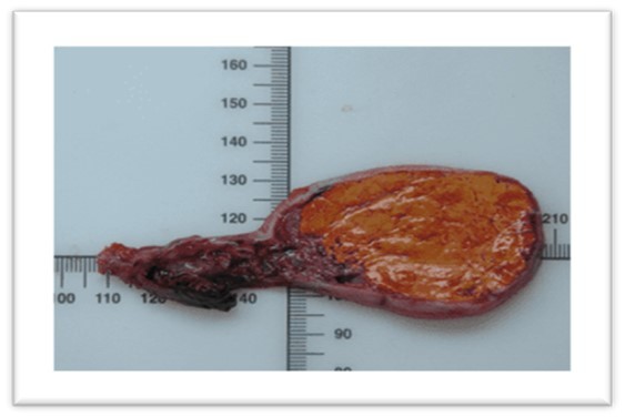 Anatomopathological and Immunohistochemistry
