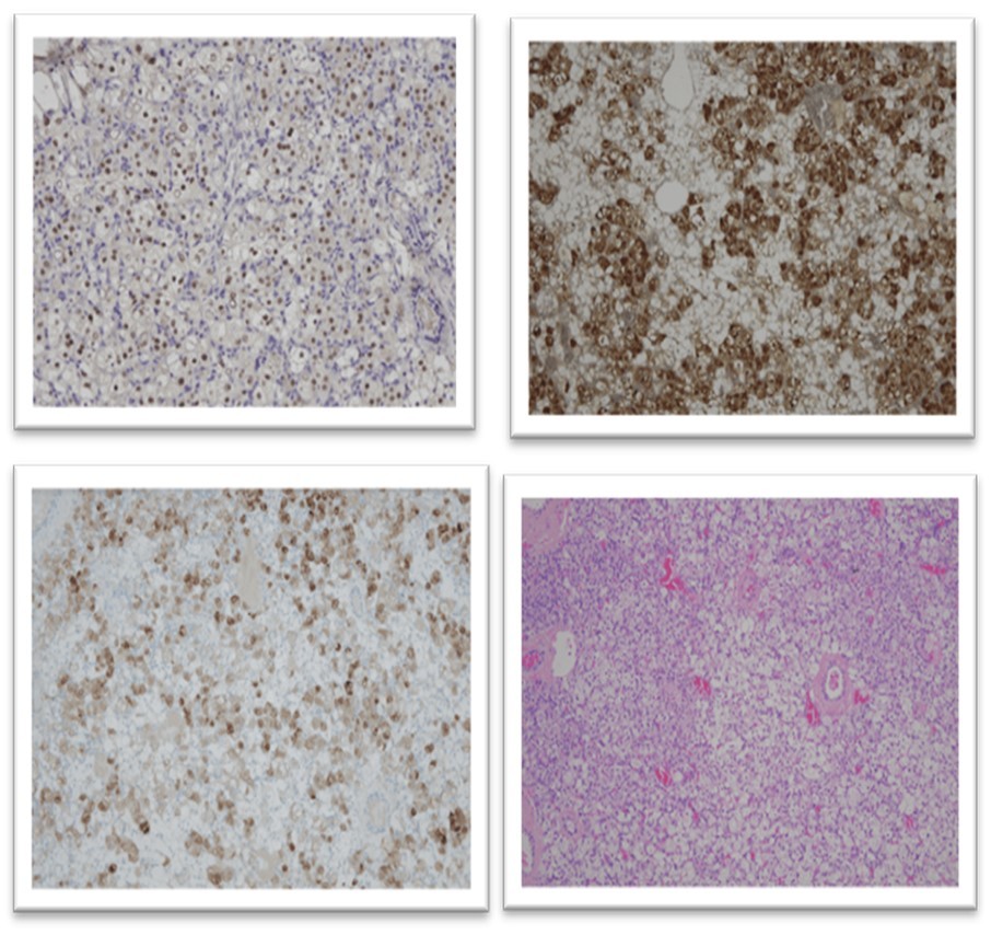 Photo HE et 4 IHC: 3 positives (inhibin, calretinin et SF1) et one negative (Melan A).