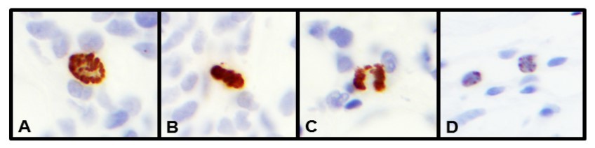 Tumor cells by PHH3 IHC (1000x). A. prophase. B. metaphase. C. anaphase D. Apoptosis, non-specific staining by IHC