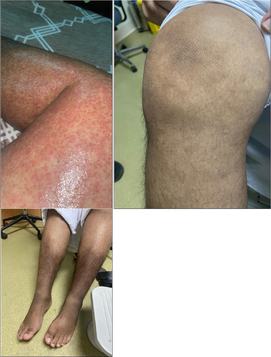 Maculopapular rash, biopsy showed evidence of vasculitis (A). After 3 months of initiation of anti-TNF (adalimumab), showed resolution of the maculopapular rash (B). Hyperpigmentation in legs (C)