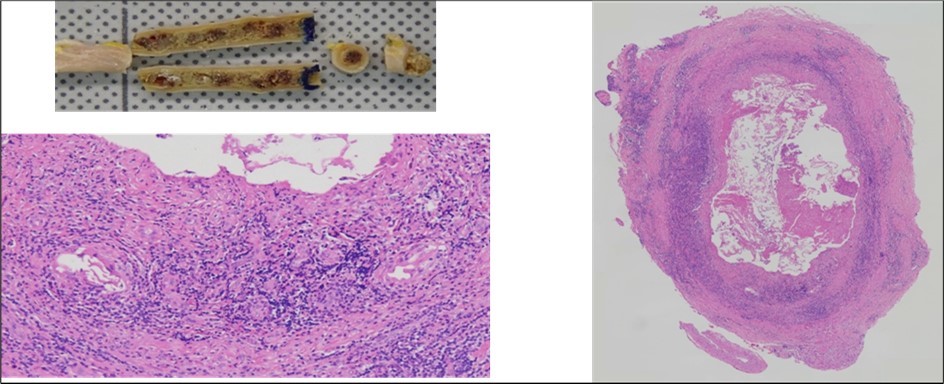 Pathological results of the vein: severe inflammatory change with granuloma formation of the vein