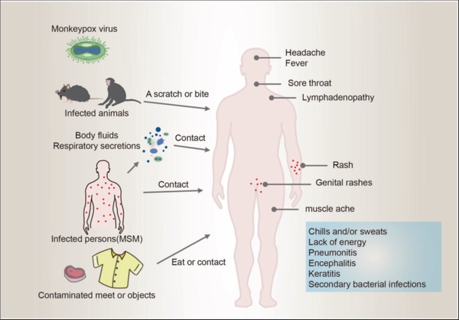 Shows the transmission and symptom of monkey pox using schematic 19.
