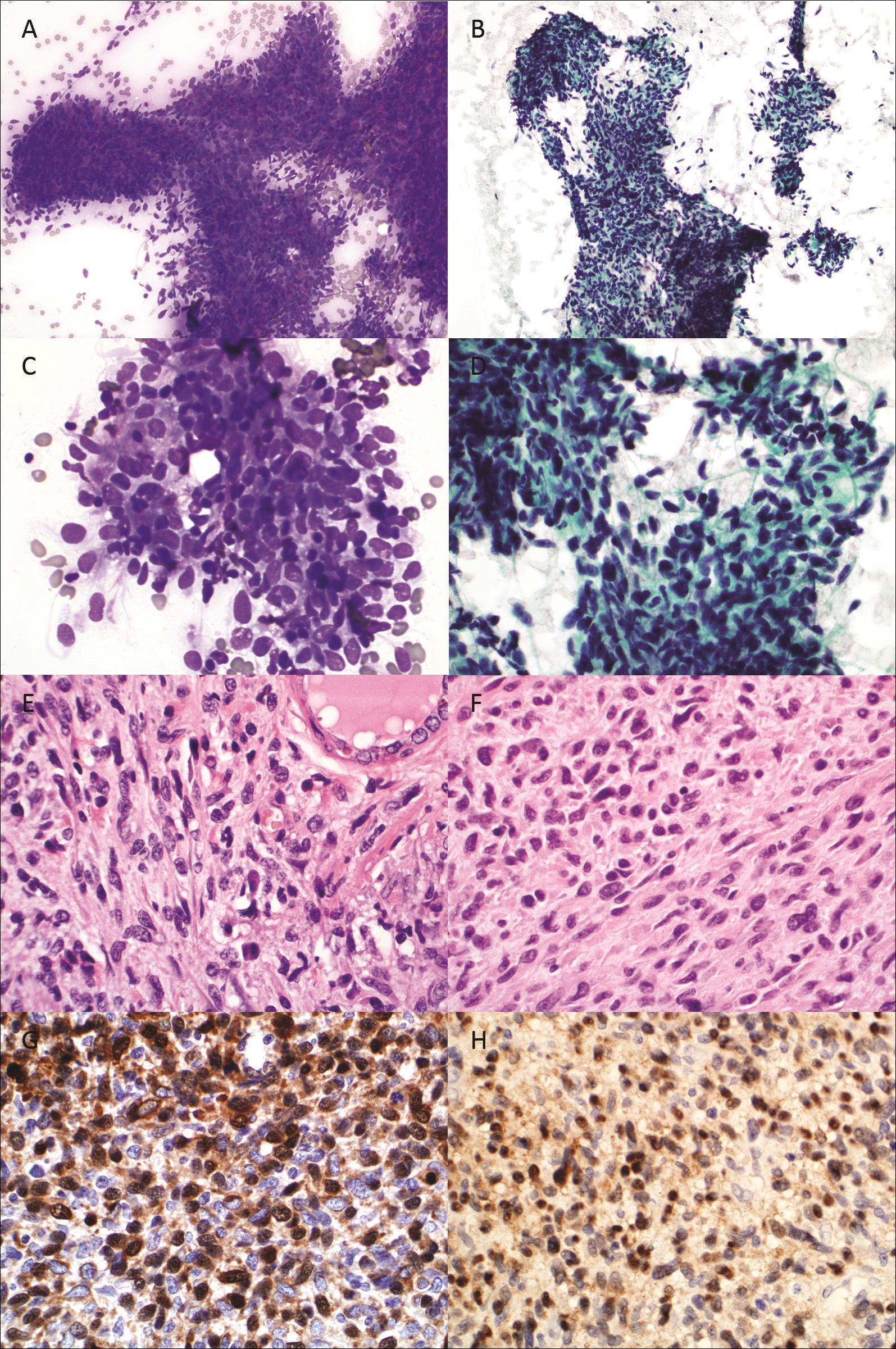 FNA cytology, Diff-Quik and Papanicolaou stain, respectively, x200. Fig. 1C and 1D: FNA cytology, Diff-Quik and Papanicolaou stain, respectively, x600. Fig. 1E and 1F: Histology from thyroid and small intestine, hematoxylin and eosin, x600. Fig. 1G and 1H: Immunostain for S100 on thyroid and small intestine, x600.