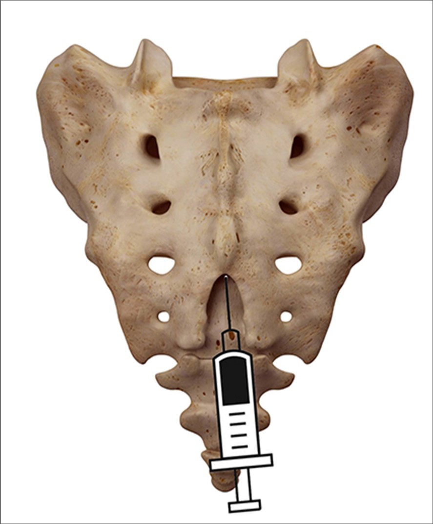 posterior view of the injection in the hiatus.