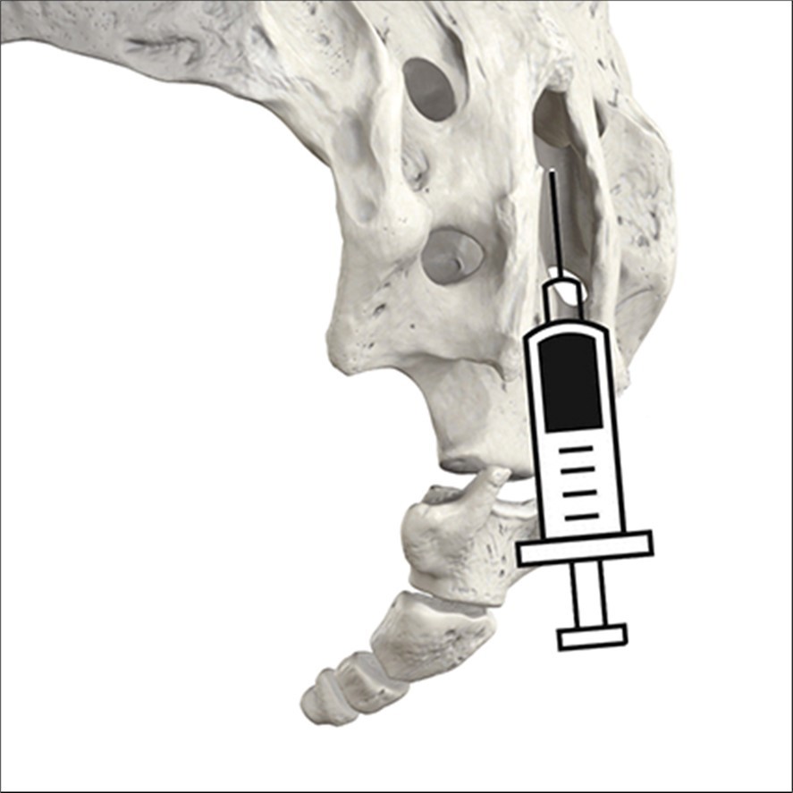oblique view of the injection in the hiatus.