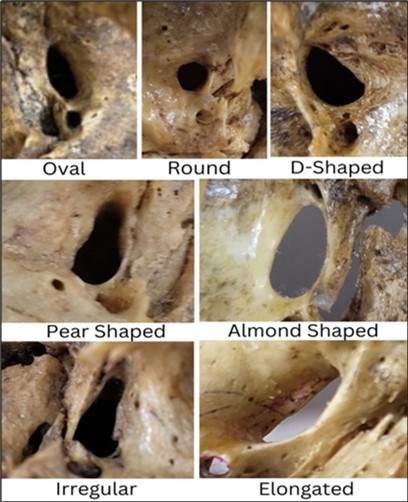 Showing different shapes of Foramen Ovale