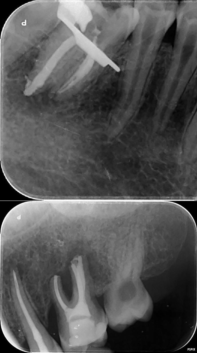 6. 7, 8, 9, and 10 showing postoperative periapical radiographs of these endodontic treatments.