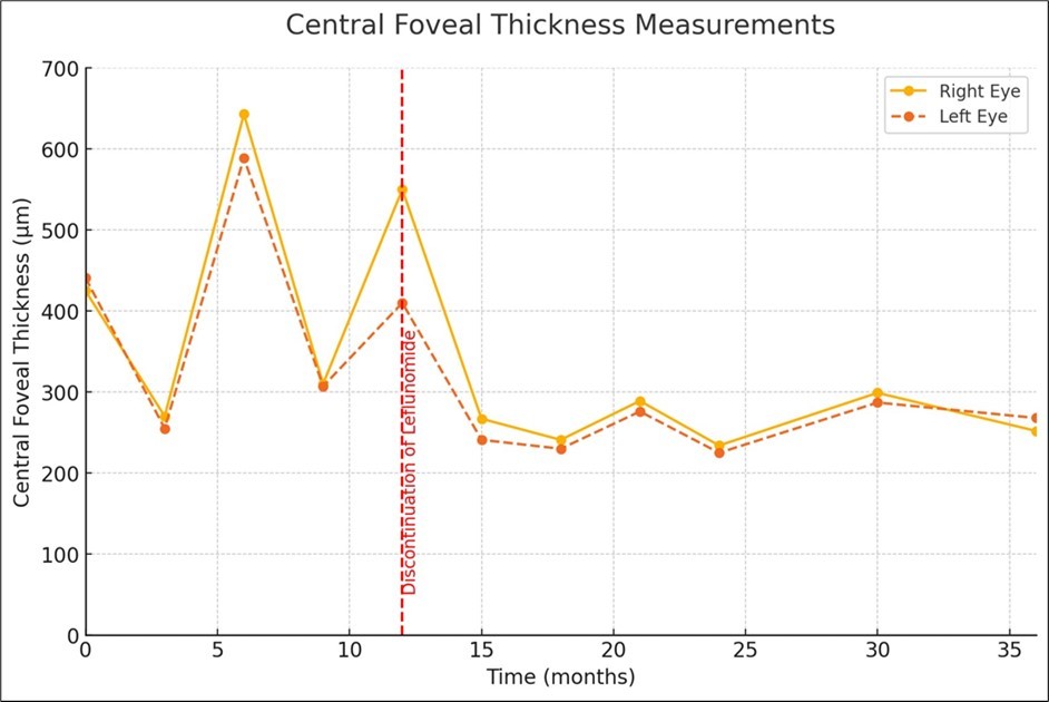 Central foveal thickness measurements before and after discontinuation of Leflunomide.