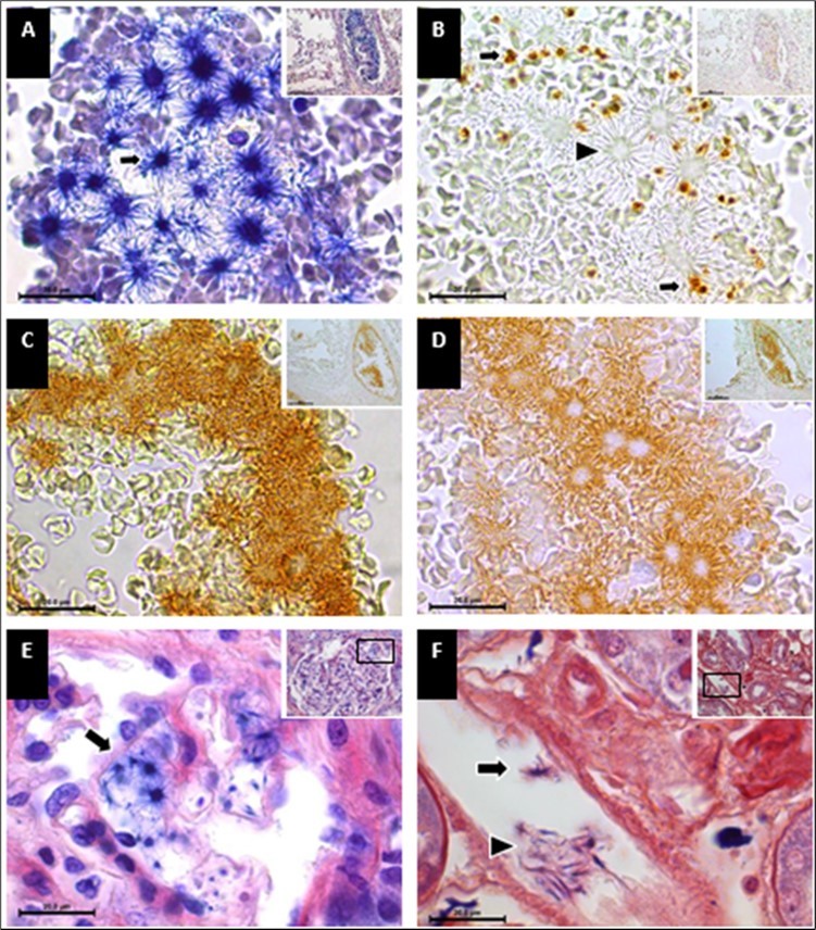 Star-shaped fibrin structures in pulmonary and renal microthrombi from deceased COVID-19 patients. (A) PTAH-stained lung arteriole with star-shaped fibrin thrombus. (B) CD61-positive platelet aggregates (arrows) in fibrin thrombus. (C-D) Thrombus immunolocalization of VWF and factor VIII. (E) Glomerular capillaries with star-shaped fibrin thrombi (arrows). (F) Fibrin strands and star-shaped fibrin in a peritubular capillary. Stains: (A, E, F) PTAH stain; (B-D) Immunoperoxidase stain. Magnifications: (A-D) 100x, insets 20x; (E-F) 100x, insets 40x.