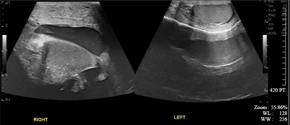 Ultrasound imaging of right and left testicles in the transverse plane.