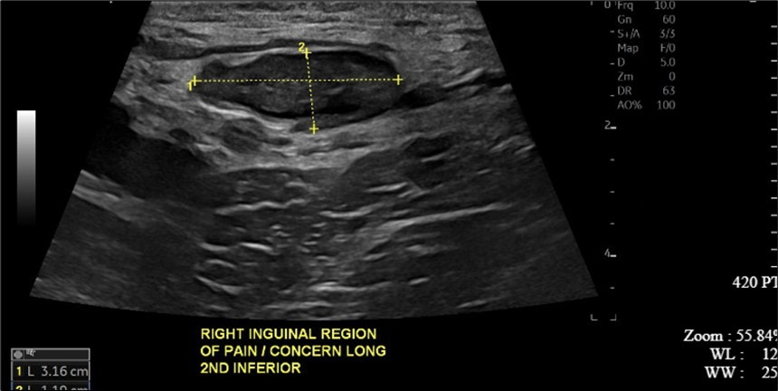 Ultrasound imaging in the transverse plane of the right inguinal region and underlying soft tissue.