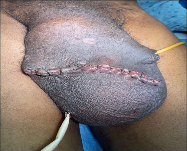 Testicular area status post hydrocelectomy and scrotoplasty with Penrose drain and Foley catheter in place.