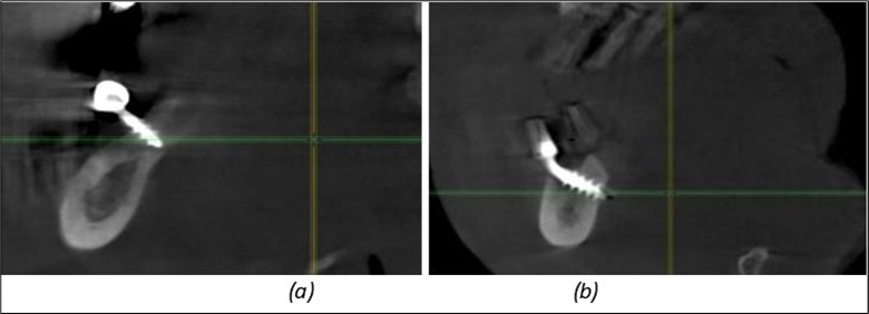 Implants fixed distally in quadrant 4 with fixation at the level of the mylohyoid line: (a) The most distal implant fixed in unaffected bone from the previous restoration; (b) The implant fixed in the area where the two stage implant was removed.