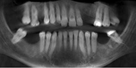 Panoramic radiograph of broken instrument
located in the apices with an extension toward
mandibular canal.