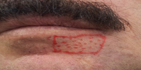 Area of paraesthesia on the first visit.