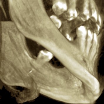 CBCT surface examination broken endodontic instrument lodged in the mandibular canal.