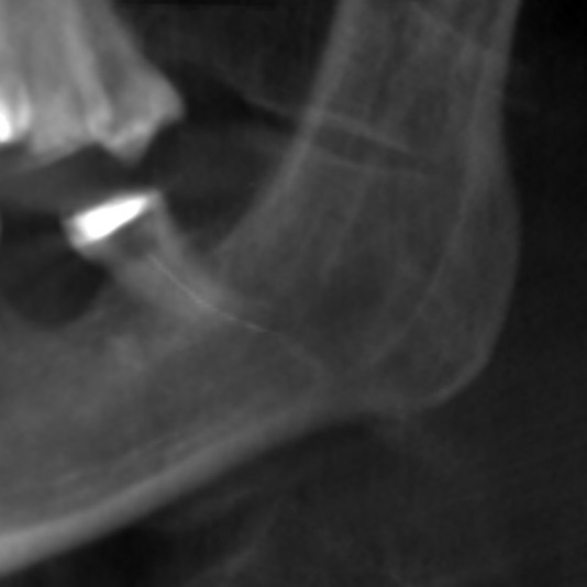 CBCT examination broken endodontic instrument lodged in the mandibular canal.