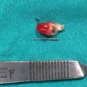 Retrieved broken endodontic instrument.
