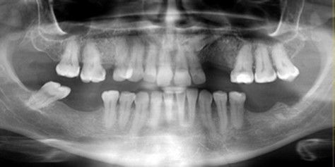 Panoramic radiographs confirmed removal of the broken endodontic instrument from the mandibular canal.