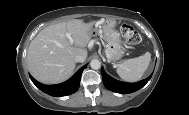 CT enterography showing gastric varices and gastric wall edema (A) .