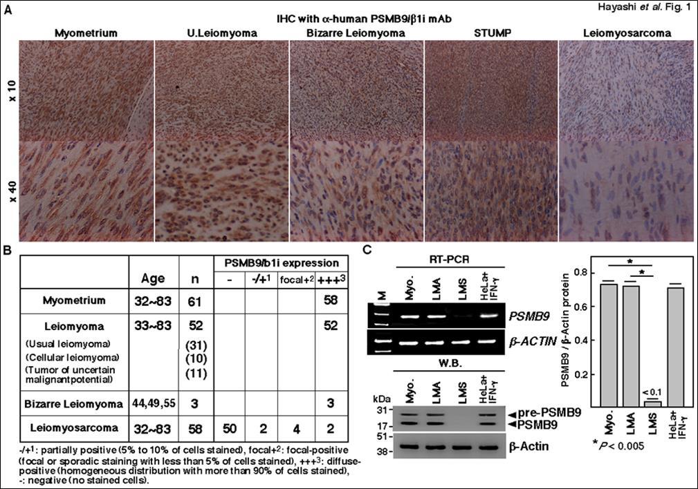 Differential expression of PSMB9/b1i expression in human normal myometrium and several mesenchymal tumour types. (A) Immunohistchemistry of PSMB9/b1i in normal myometrium, usual leiomyoma, Bizarre leiomyoma, smooth muscle tumour of uncertain malignant potential (STUMP) and uterine leiomyosarcoma tissues located in same tissue. For all samples, 5-mm sections of tissues specimens were stained with anti- PSMB9/b1i antibody revealed by peroxidase-cojugated anti-rabbit IgG antibody. (B) IHC experiments individually performed at several medical facilities revealed a marked loss in the ability to induce PSMB9/b1i expression in human uterine LMS tissues compared to that in normal human myometrium located in the same tissue section, as well as to that in LMA tissues. Normal total: 58 cases, LMA total: 50 cases, Bizarre Leiomyoma total: 3 cases, LMS total: 56 cases. The experiments were performed three times with similar results. (C) Examinations of mRNA expression for PSMB9/b1i and b-ACTIN in normal human myometrium (Myo.), uterine usual leiomyoma (LMA), uterine leiomyosarcoma (LMS) and IFN-g-treated HeLa cells by reverse transcription-polymerase chain reaction (RT-PCR). RT-PCR was performed with the appropriate primers indicated in the materials and methods section of this manuscript. The DNA products amplified by RT-PCR were loaded in agarose gel. The expression levels of PSMB9/b1i and b-ACTIN were examined by western blotting with appropriate antibodies. The cytosolic extracts were prepared from normal human myometrium, uterine usual leiomyoma (LMA) and uterine leiomyosarcoma (LMS), and IFN-g-treated HeLa cells, and 50 mg of cytosolic extracts were resolved by 10% sodium dodecyl sulfate-polyacrylamide gel (SDS-PAGE). PSMB9/b1i levels were significantly decreased in human uterine LMS compared with normal human myometrium and human usual LMA. Student’s t-test. *P < 0.005. (n = 8 per group).