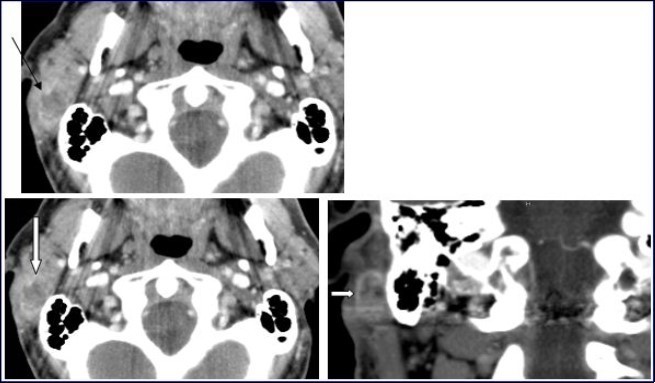 Computed Tomography of the neck with intravenous contrast material revealed a focal lesion in the right parotid gland with size 3 × 2-cm. The mass was well defined, heterogeneous, with peripheral contrast enhancement (large white arrow). It had a central attenuation value of 13 HU, suggesting a necrotic mass without bony involvement (thin black arrow).